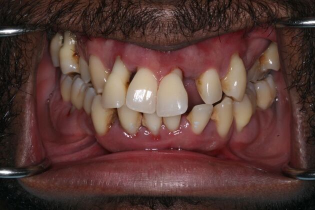 All-on-4/ Full Mouth Dental Implants / Teeth in a Day: Case 21-Severe gum disease and failing teeth treatment with Upper and Lower Full Arch Implant Bridges - Before