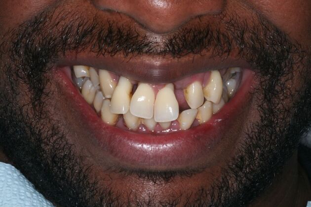 All-on-4/ Full Mouth Dental Implants / Teeth in a Day: Case 21-Severe gum disease and failing teeth treatment with Upper and Lower Full Arch Implant Bridges - Before