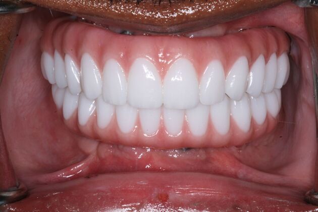 All-on-4/ Full Mouth Dental Implants / Teeth in a Day: Case 21-Severe gum disease and failing teeth treatment with Upper and Lower Full Arch Implant Bridges - After