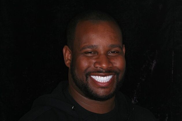 All-on-4/ Full Mouth Dental Implants / Teeth in a Day: Case 21-Severe gum disease and failing teeth treatment with Upper and Lower Full Arch Implant Bridges - After