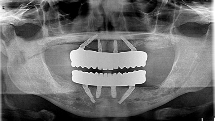 All-on-4/ Full Mouth Dental Implants / Teeth in a Day: Case 21-Severe gum disease and failing teeth treatment with Upper and Lower Full Arch Implant Bridges - After