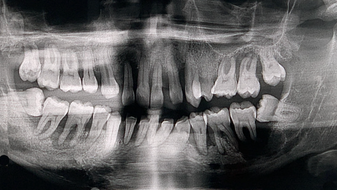 All-on-4/ Full Mouth Dental Implants / Teeth in a Day: Case 21-Severe gum disease and failing teeth treatment with Upper and Lower Full Arch Implant Bridges - Before