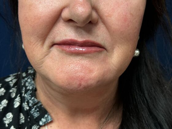 Cosmetic Injectables & Fillers*: Facial Balancing Case 2 - After
