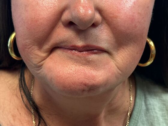 Cosmetic Injectables & Fillers*: Facial Balancing Case 2 - Before