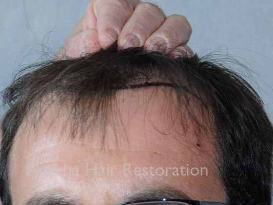 Hair Transplant Results Case 1 - Before