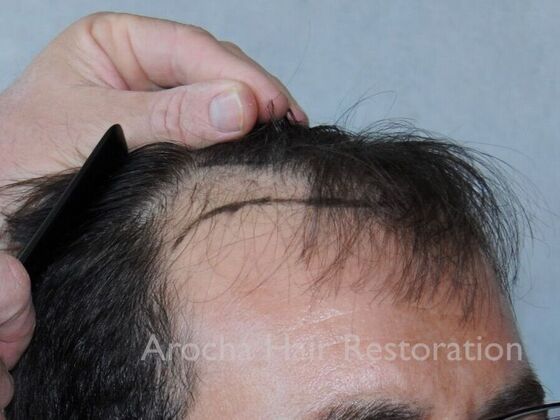 Hair Transplant Results: Case 1 - Before