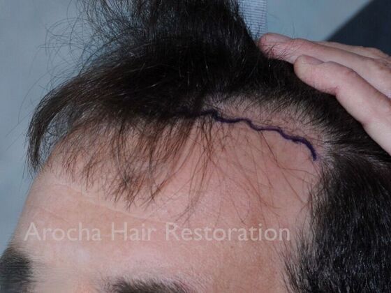 Hair Transplant Results: Case 1 - Before