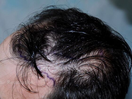 Hair Transplant Results: Case 1 - Before
