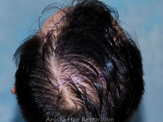 Hair Transplant Results: Case 1 - Before