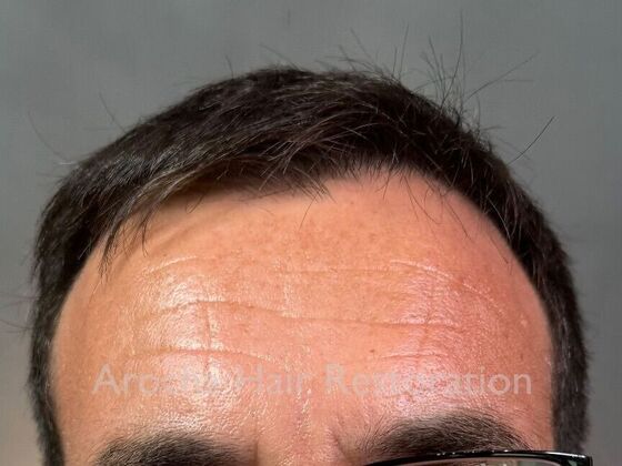 Hair Transplant Results Case 1 - After