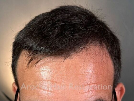 Hair Transplant Results: Case 1 - After