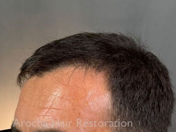 Hair Transplant Results: Case 1 - After