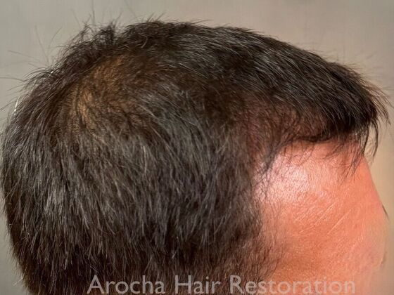 Hair Transplant Results: Case 1 - After