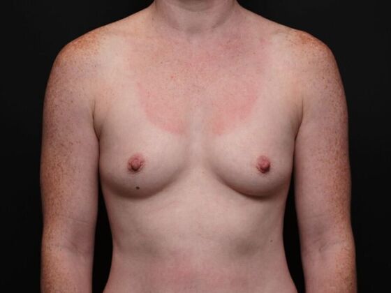 Breast Augmentation Case 1 - Before