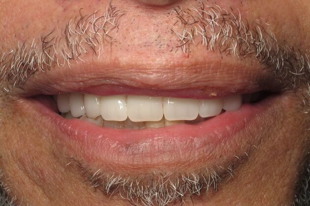 Teeth in a Day: Thrilled to have to smile - After