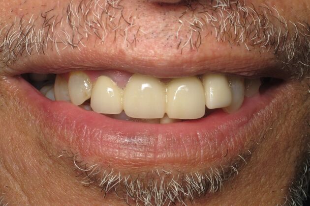 Teeth in a Day: Thrilled to have to smile - Before