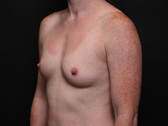 Breast Augmentation: Case 1 - Before