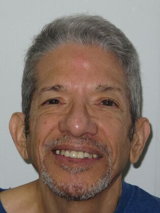 Teeth in a Day: Thrilled to have to smile - Before