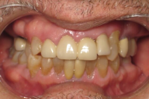 Teeth in a Day: Thrilled to have to smile - Before