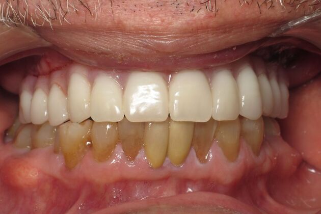 Teeth in a Day: Thrilled to have to smile - After