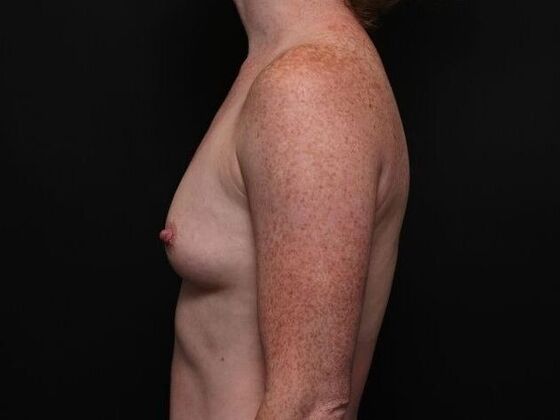 Breast Augmentation: Case 1 - Before