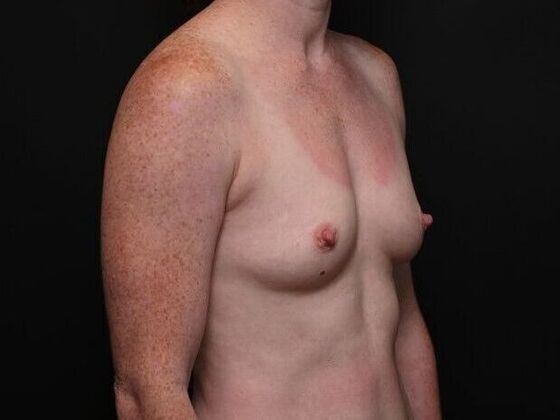 Breast Augmentation: Case 1 - Before