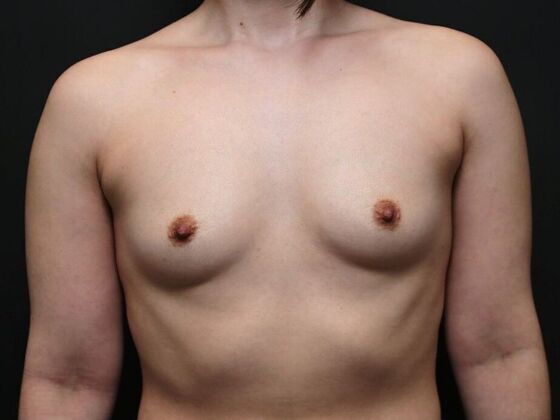 Breast Augmentation Case 2 - Before