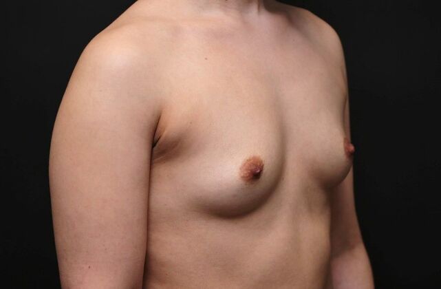 Breast Augmentation: Case 2 - Before