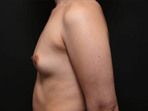 Breast Augmentation: Case 2 - Before