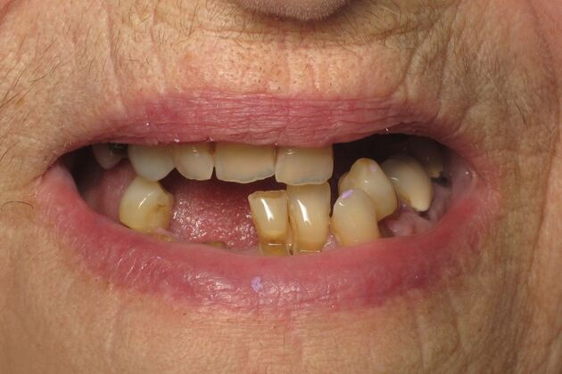 Teeth in a Day: Wow, another dramatic transformation - Before