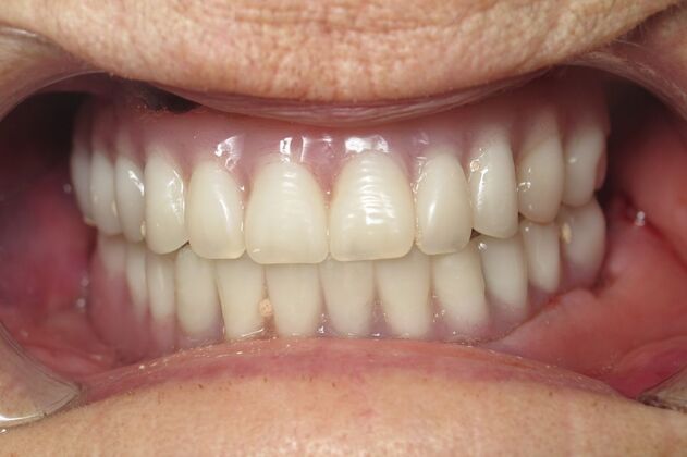 Teeth in a Day: Wow, another dramatic transformation - After