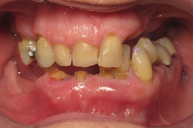 Teeth in a Day: Wow, another dramatic transformation - Before