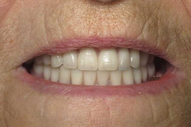 Teeth in a Day: Wow, another dramatic transformation - After