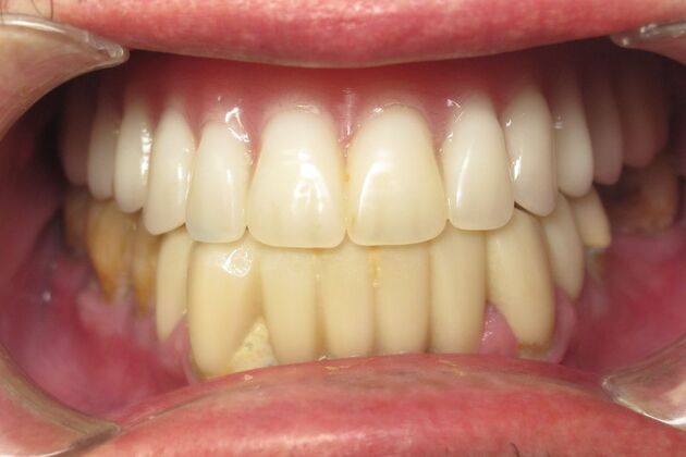 Teeth in a Day: Embarrassment in rearview mirror - After