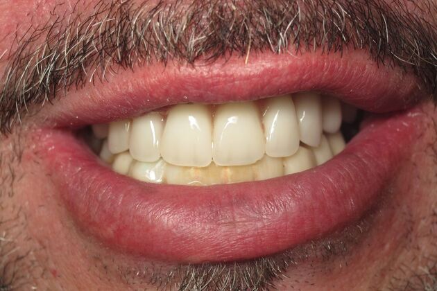 Teeth in a Day: Embarrassment in rearview mirror - After