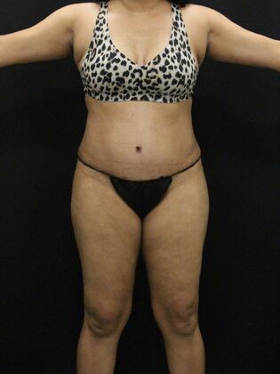 Tummy Tuck Case 43 - After