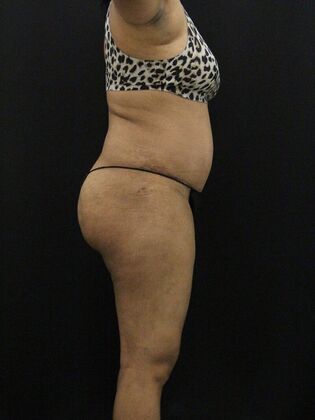 Tummy Tuck: Case 43 - After