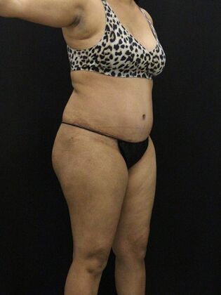 Tummy Tuck: Case 43 - After