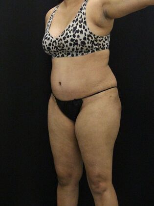 Tummy Tuck: Case 43 - After