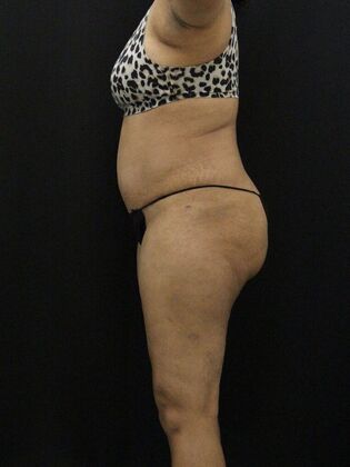 Tummy Tuck: Case 43 - After