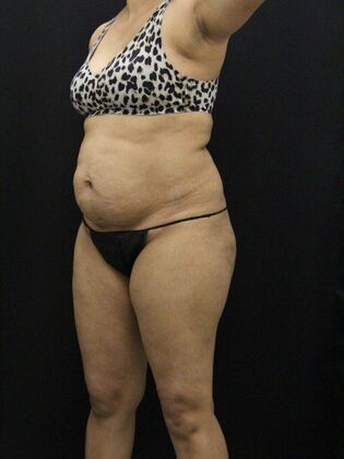 Tummy Tuck: Case 43 - Before