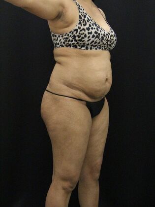 Tummy Tuck: Case 43 - Before