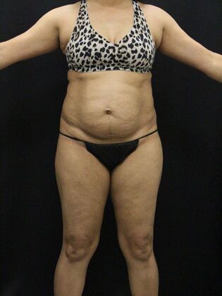 Tummy Tuck Case 43 - Before