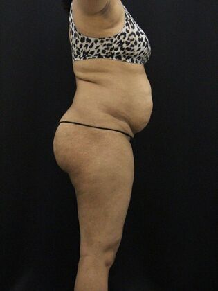 Tummy Tuck: Case 43 - Before