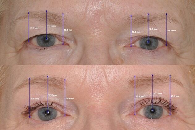 Endoscopic Browlift: Endoscopic browlift measuremnets at 1 year after - Before and after 