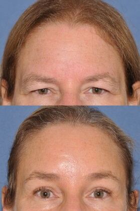 Endoscopic Browlift Endoscopic Brow/Upper lids/Glabellaplasty (weaken the 11