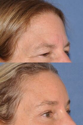 Endoscopic Browlift Endoscopic Brow/Upper lids/Glabellaplasty (weaken the 11