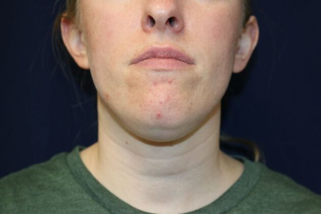 Neck Sculpting : Case 11 - Before