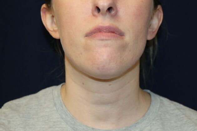 Neck Sculpting : Case 11 - After