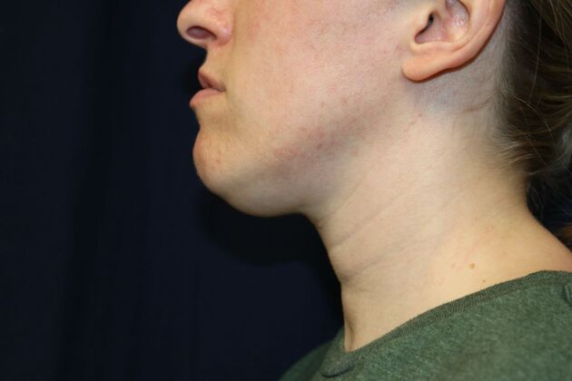 Neck Sculpting : Case 11 - Before